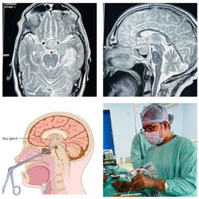Early antiplatelet medication linked to improved stroke recovery